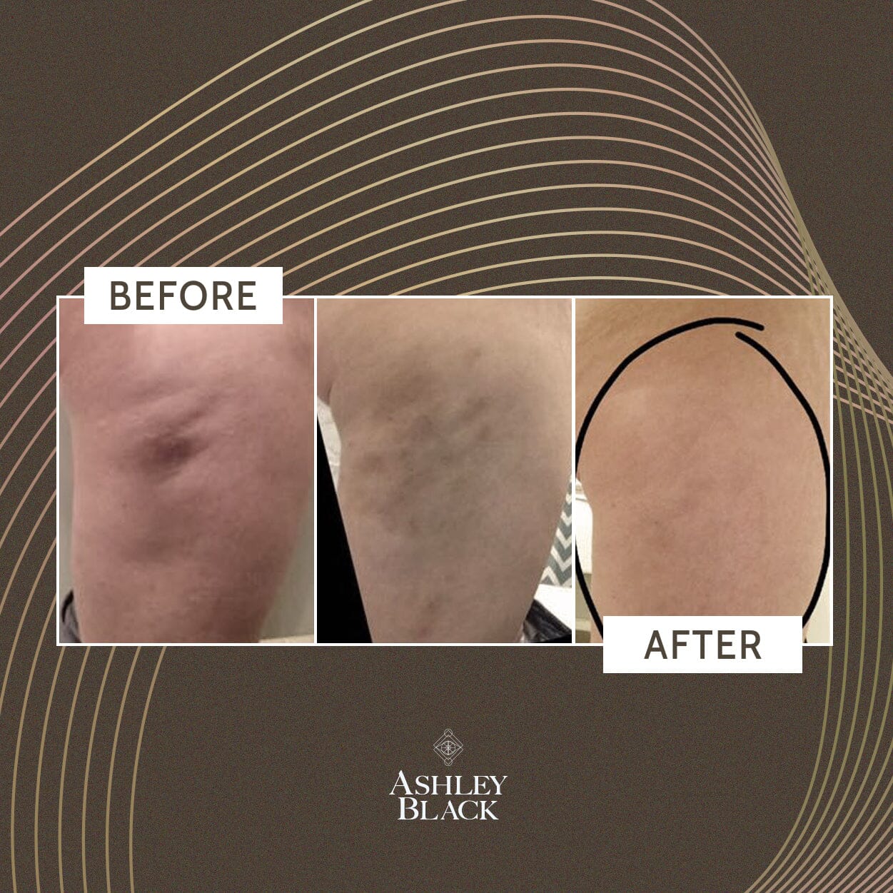 FasciaBlaster® Nugget - Image 10